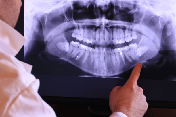 Best Emergency Dentist for Lost Fillings or Crowns in Norwalk, OH